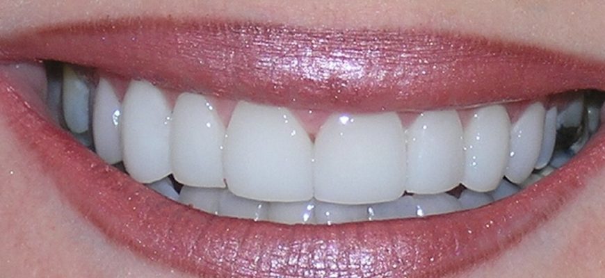 Люминыры на зубы